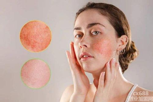 面部皮肤过敏红痒怎么办？敏感肌肤实用护肤技巧