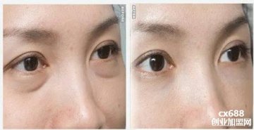 关于眼袋的三大误区怎么去除眼袋？