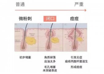 闭口是怎么产生的?闭口应该怎么去除